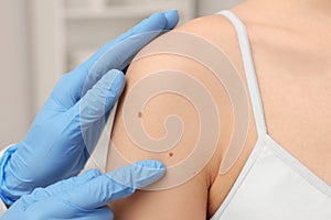 Dermatologist examining patient's birthmark indoors, closeup view