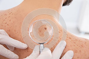 Dermatologist examining patient`s birthmark with magnifying glass in clinic