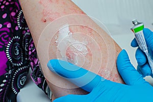 A dermatologist in gloves applies a therapeutic ointment to the affected skin of a patient with psoriasis. Treatment of chronic