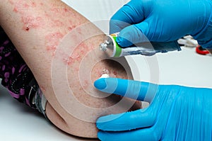 A dermatologist in gloves applies a therapeutic ointment to the affected skin of a patient with psoriasis. Treatment of chronic