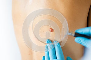 Dermatologist looking ar birthmark on patient`s skin photo