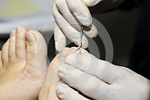 Dermatologist makes inspection, nail fungus