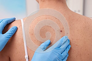 Dermatologist in rubber glove examining patient's birthmark, closeup