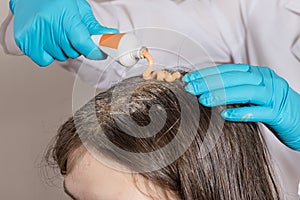 A dermatologist or trichologist applies a dandruff or lice weed to the patient& x27;s hair. Treating psoriasis, hair loss
