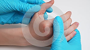 Dermatologist wearing medical gloves examines child hand with viral warts, thinks through course treatment,close-up