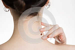 Dermatology. Close-up of a woman`s neck. The hand shows a large mole. The concept of checking moles for malignancy
