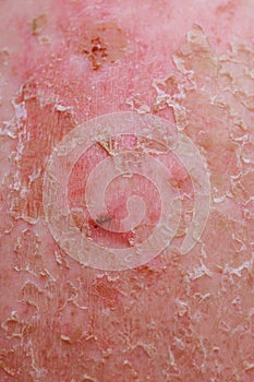 Dermatology professionals often encounter cases of a psoriatic eczema in their practice.