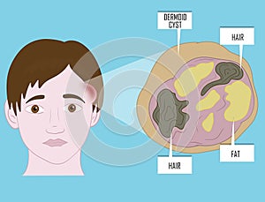 Dermoid cysts symptoms on young patient face. Illustration