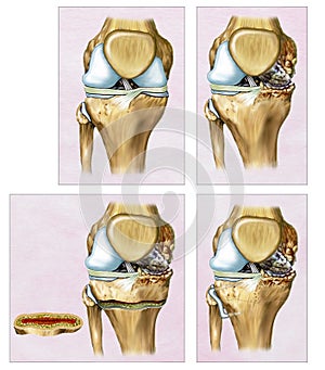 Descriptive illustration an Osteotomy or correction of the knee where the femur and tibia appear crooked.