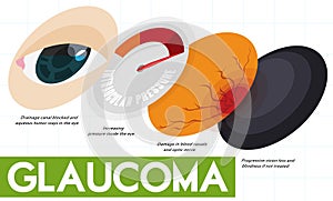 Descriptive Infographic Showing Some Stages of Glaucoma Disease, Vector Illustration