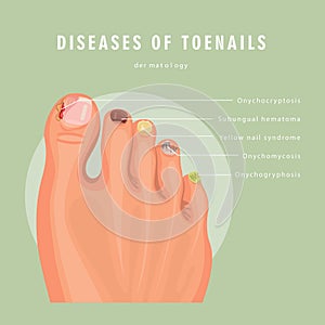 Deseases of toenails vector medicine card. Colorful design. Detailed image with text.