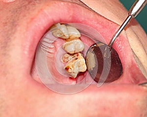 Destroyed by caries teeth