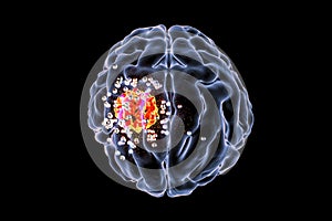 Destruction of brain tumor by nanoparticles