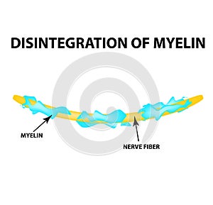The destruction of the myelin sheath on the axon. Damaged myelin. Neuron affected by multiple sclerosis. World Multiple photo