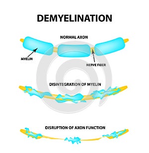 The destruction of the myelin sheath on the axon. Damaged myelin. Neuron affected by multiple sclerosis. World Multiple