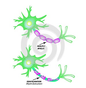 The destruction of the myelin sheath on the axon. Damaged myelin. Neuron affected by multiple sclerosis. World Multiple