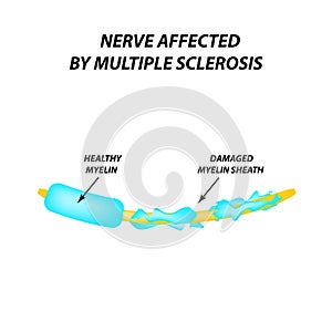 The destruction of the myelin sheath on the axon. Damaged myelin. Neuron affected by multiple sclerosis. World Multiple