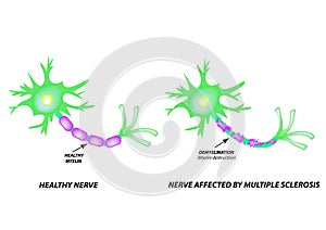 The destruction of the myelin sheath on the axon. Damaged myelin. Neuron affected by multiple sclerosis. World Multiple