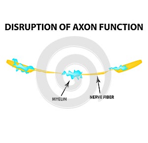The destruction of the myelin sheath on the axon. Damaged myelin. Neuron affected by multiple sclerosis. World Multiple photo