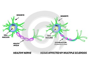 The destruction of the myelin sheath on the axon. Damaged myelin. Neuron affected by multiple sclerosis. World Multiple photo