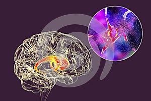 Destruction of neurons of the caudate nucleus, conceptual 3D illustration