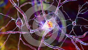 Destruction of neurons of Dorsal striatum, conceptual 3D illustration photo