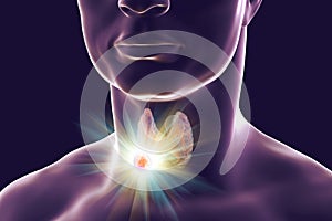 Destruction of thyroid tumor