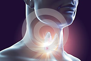 Destruction of thyroid tumor