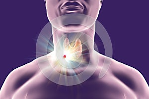 Destruction of thyroid tumor
