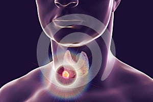 Destruction of thyroid tumor