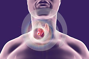 Destruction of thyroid tumor