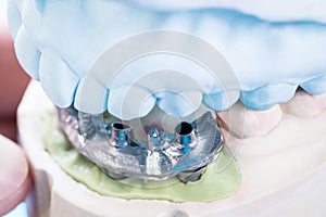 Detail the bar of dental implant.
