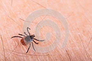 Detail of deer tick on human skin. Ixodes ricinus