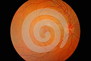 Detail of eye diabetes isolated