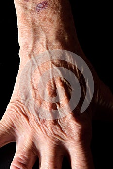 Detail of the hand and wrist of an elderly woman with a bruise