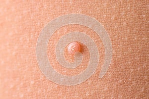 Detail of a molluscum contagiosum nodule produced by the Molluscipoxvirus virus on the skin of the abdomen of a child