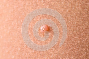 Detail of a molluscum contagiosum nodule produced by the Molluscipoxvirus virus on the skin of the abdomen of a child photo