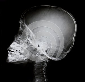 Detail of neck and head x-ray