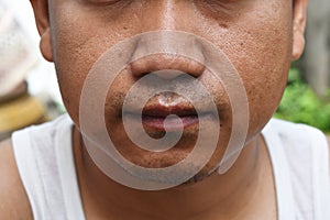 Pores and oily on surface young asian man face skin do not take care for a long time