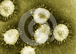 Detail of ultraestructure of deadly coronavirus particles under transmission electron microscopy TEM