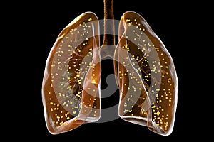 Human lungs affected by miliary tuberculosis, 3D illustration