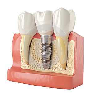 Detailed medical illustration of a dental implant in the jawbone. photo