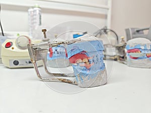 Detailed plaster models with dentures analogs in the dental laboratory
