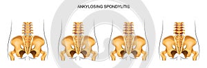 The development of ankylosing spondylitis in the lumbar spine