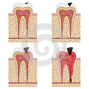 Development of dental caries illustration.