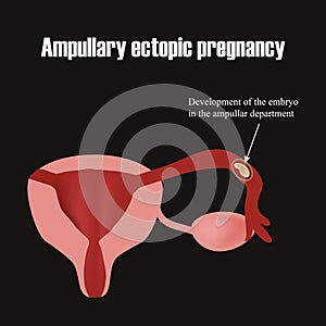 Development of the embryo in the ampullar department. Ectopic pregnancy. Infographics. Vector illustration