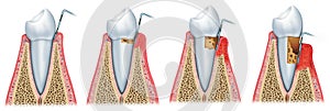 Development of periodontitis photo