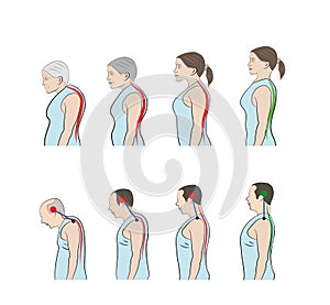 Development of a stooped stance with age, showing