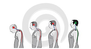 Development of a stooped stance with age, showing increasing curvature of the spine