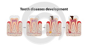 Development of tooth disease medical poster illustration in flat design. Teeth in gum icons isolated on white background